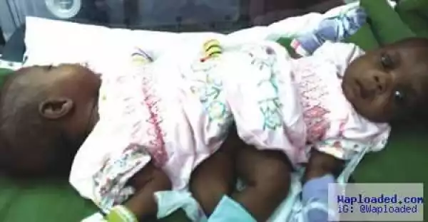 Photos : Woman Delivers Conjoined Twins In Enugu